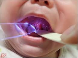Image result for Uvulitis