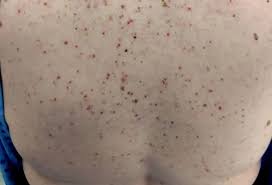 Image result for Urticaria pigmentosa children
