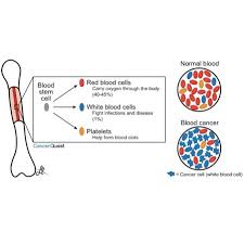 When doctors talk about second cancers, they mean a different tissue type or a different site, not a recurrence or spread of the original tumor. Leukemia Cancerquest
