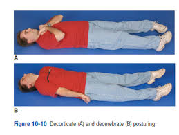 Glasgow Coma Scale Adult And Pediatric From International Trauma Life Support Itls Tom Wade Md