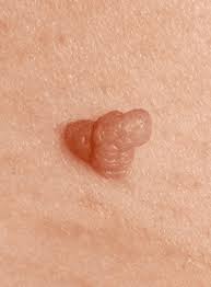 Image result for genital warts