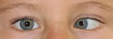 Schielen Auge Online
