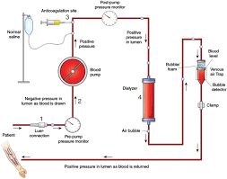 Diagnosis Treatment And Prevention Of Hemodialysis Emergencies American Society Of Nephrology