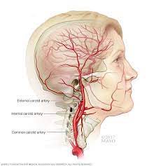 The head and neck receive the majority of blood through the carotid and vertebral arteries. Carotid Artery Disease Symptoms And Causes Mayo Clinic