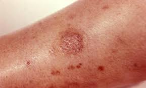 Bug Bite With Black And Blue Ring Around It Pin On Health Fitness