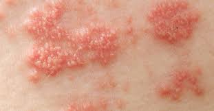 Image result for shingles