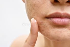 48 325 Acne Fotos Fotos De Stock Gratuitas E Fotos Royalty Free Dreamstime