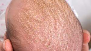 Check spelling or type a new query. Neurodermitis In Bildern So Sieht Neurodermitis Aus