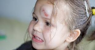 We did not find results for: Concussion Or Head Injury Babycenter Toddler Head Injury Baby Center Head Injury