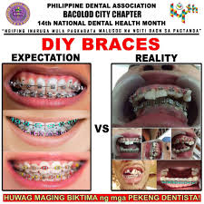 For more information about lifesmiles dental care in iloilo city please contact the clinic. Professional Teeth Whitening Cost Philippines Teethwalls