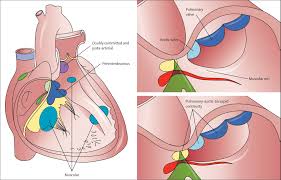 Image result for Ventricular Septal Defect