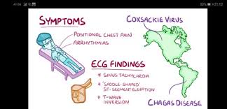 Myocarditis is an inflammation of the heart muscle (myocardium). Q9 Myocardial Diseases Myocarditis Osmosis Flashcards Quizlet