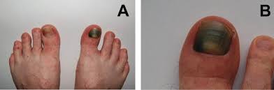 Image result for Onycholysis feet