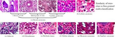Different kinds of breast cancer. Breast Cancer Multi Classification From Histopathological Images With Structured Deep Learning Model Scientific Reports