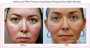 Homemade Natural Face Wash Remedies For Rosacea Get Rid Of Redness And Bumps Caused By Rosacea Natural Rosacea Rosacea Treatment Rosacea