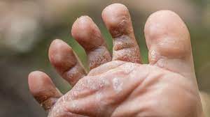 Does hand sanitizer kill ringworm? Ringworm On Foot Symptoms Treatment Prevention
