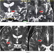 Image result for Pallidotomy