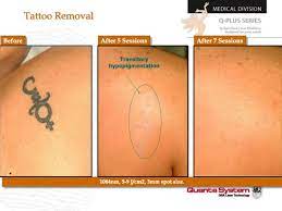 Tattoo removal centers in san francisco. Laser Tattoo Removal In San Francisco Ca Advanced Aesthetics