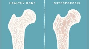 Osteoporosis is a condition of fragile bone with an increased susceptibility to fracture. Osteopenia And Osteoporosis Should Women Worry Elite Learning