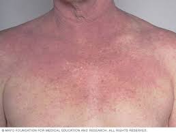 Image result for Atopic eczema atopic dermatitis