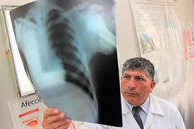 La fibrosis pulmonar idiopática (fpi) es una enfermedad debilitante y crónica que se caracteriza por una disminución progresiva de la función pulmonar que dificulta cada vez más la respiración. Fibrosis Pulmonar Idiopatica Es Mas Frecuente En Adultos A Partir De Los 50 Anos Noticias Agencia Peruana De Noticias Andina