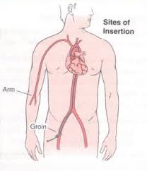 Image result for Cathormion