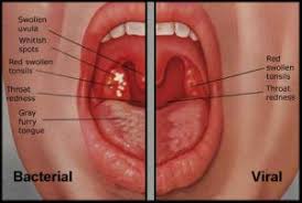 Image result for Tonsillitis