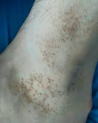 Was Konnten Diese Braunen Flecken Auf Den Fussen Sein Gesundheit Korper Haut