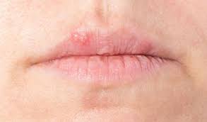 Ils sont très contagieux quoique bénins. 4 Questions Sur Le Bouton De Fievre Passionsante Be