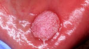 Check spelling or type a new query. Sabe Que Responder A Sus Pacientes Sobre El Vph Dental Tribune Latin America