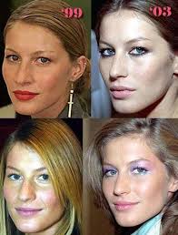 Gisele Bundchen Is Listed Or Ranked 5 On The List Celebrity Nose Jobs Before And After In 2020 Hair Implants Celebrity Plastic Surgery Cool Hair Color