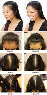 Whatever your age, identifying the cause and addressing it early gives you the best chance of stopping or reversing it. 13 Best Hair Loss Causes Ideas Hair Loss Hair Loss Causes Hair