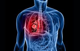 Rak pluća je bolest za koju je karakterističan nekontrolisan ćelijski rast u tkivima pluća. Rak Pluca Je Podmukao Jer Su Simptomi U Prvoj Fazi Spori I Neprimetni Eklinika