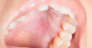 Image result for Mouth ulcers symptoms roof of the mouth