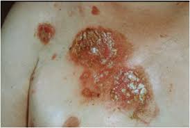 Image result for Pemphigus