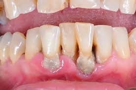 Gum Disease Cause Amp Prevention Gum Disease Treatment Gum Disease Gum Health