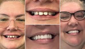 Before & After Dental Implants Gallery