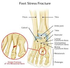 Image result for Toe Fracture