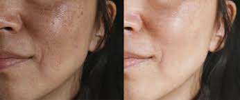 Mesmo que seja um caso recorrente de melasma, é importante verificar com o especialista o tipo e. Tranexamic Acid For Melasma