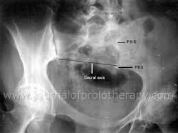 Lazy sundaypain, just pain (i.redd.it). Sacroiliac 201 Dysfunction And Management A Biomechanical Solution Journal Of Prolotherapy