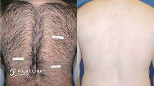 It only affects the specific structures of the hair and follicle, leaving the surrounding. Laser Hair Removal Men Pulse Light Clinic London