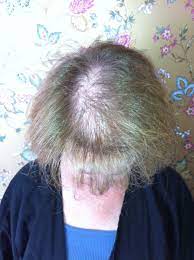 Hope you are taking good care of yourselves and your health! Hairdreams Volume System Hair Extensions For Thin Hair Sufferers Of Trichotillomania Anastasia Molchanov Hair Salon