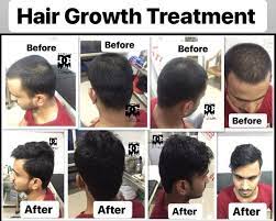 The main reason for hair loss is dht and it also destroys hair follicles. Hair Growth With Results After Hijama Cupping Therapy Facebook