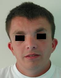 Nouveaux mécanismes moléculaires impliqués dans l'insensibilité à l'hormone  de croissance