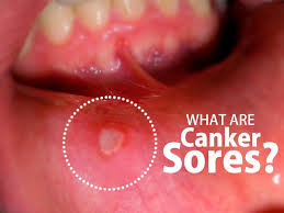 Canker Sores Or Aphthous Ulcers Are Shallow Painful Sores Inside The Mouth They Are Usually Red Or May Sometimes Have Sore Lips Canker Sore Blister In Mouth