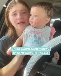 I blame myself for what has happened to my baby's face… I don't know what  to do 😣