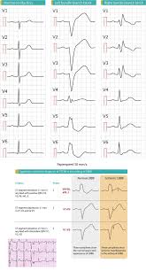 Left Bundle Branch Block Lbbb Ecg Criteria Bundle Branch Block Cardiac Nursing Medical Student Study