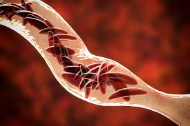 Sickle cell disease is a blood disorder in which the hemoglobin is damaged and can't carry oxygen to the tissues. Guide To Sickle Cell Disease