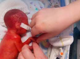 Check spelling or type a new query. Mother Reveals How Her Premature Baby Was Born With Red Skin So Transparent Her Brain Was Visible The Independent The Independent