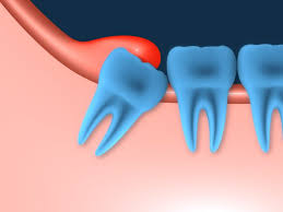 You might also feel soreness and an urge to itch in the region. Can I Keep My Wisdom Teeth Southwest Family Dentistry